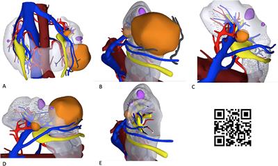 Case Report: Optimizing Pre- and Intraoperative Planning With Hyperaccuracy Three-Dimensional Virtual Models for a Challenging Case of Robotic Partial Nephrectomy for Two Complex Renal Masses in a Horseshoe Kidney